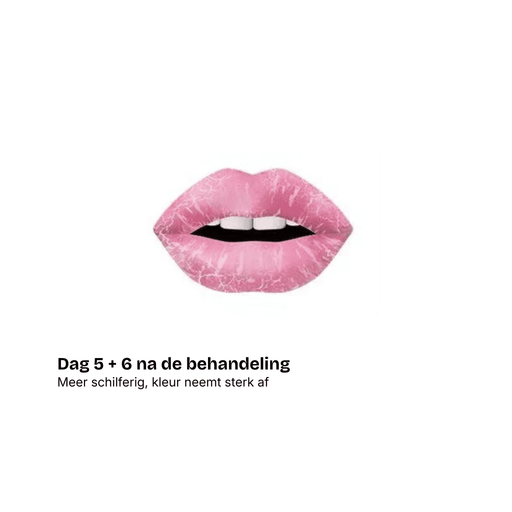 Een paar lichtroze lippen met zichtbare droogheid en schilfering, die het effect laten zien na een lipblush behandeling. De Nederlandse tekst luidt: "Dag 5 + 6 na de behandeling. Meer schilferig, kleur neemt sterk af," met aantekening van toegenomen schilfering en vervagende kleur.