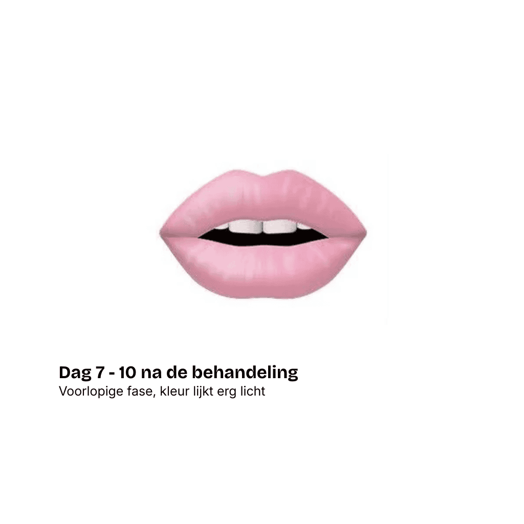 Illustratie van roze lippen die iets uit elkaar staan, waardoor witte tanden zichtbaar worden. Onderaan staat de Nederlandse tekst: Dag 7-10 na de behandeling. Voorlopige fase, kleur lijkt erg licht - een demonstratie van het PMU proces in een schoonheidssalon in Schijndel.