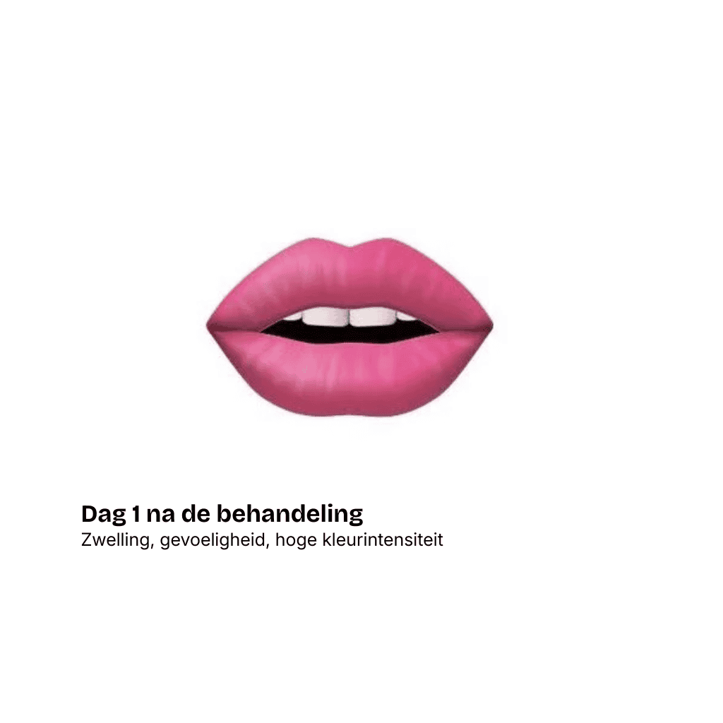 Illustratie van felroze lippen met iets open mond. Tekst: Dag 1 na de behandeling in de beautysalon. Zwelling, gevoeligheid en hoge kleurintensiteit links onder de lippen, op een witte achtergrond.
