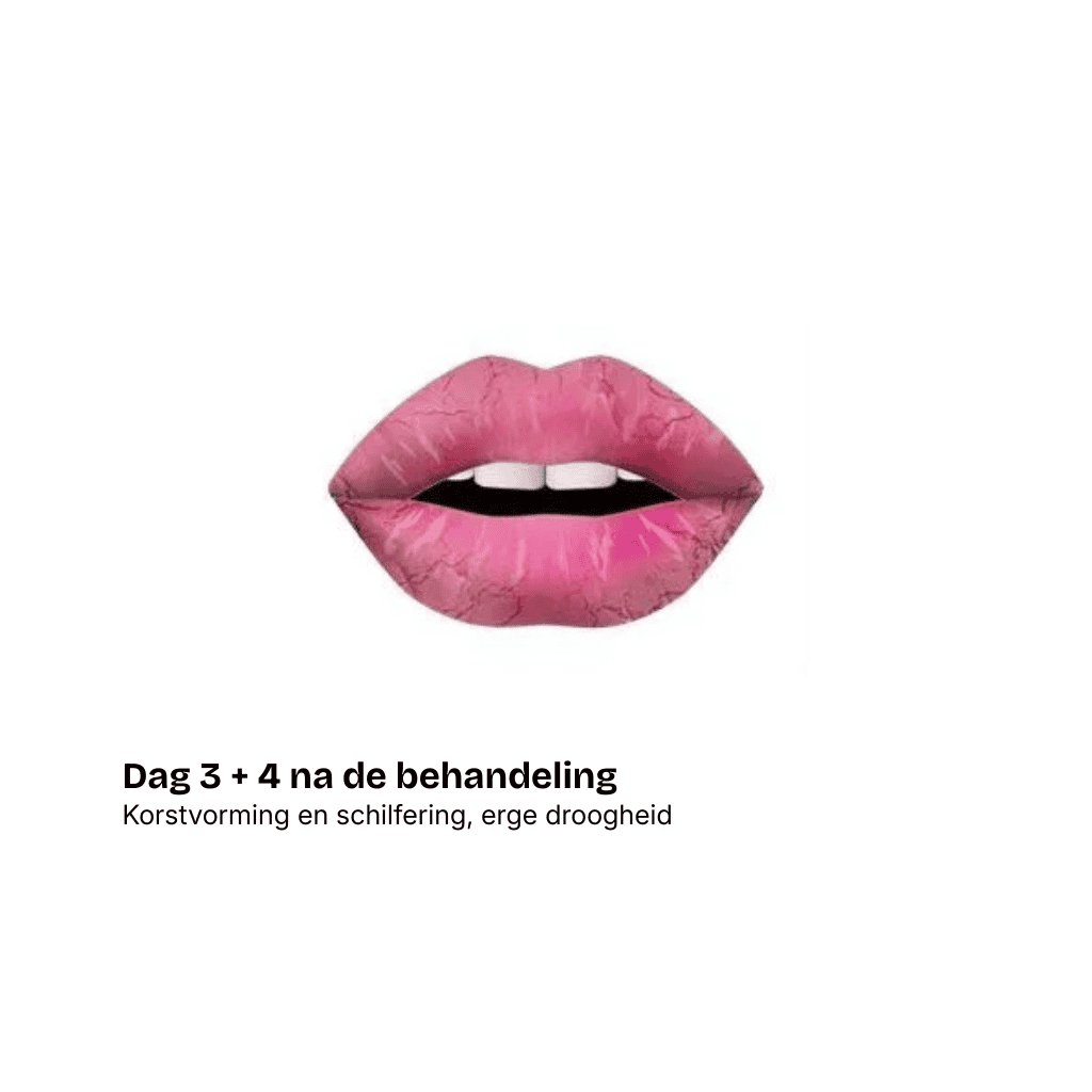 Illustratie van roze lippen met zichtbare droogheid en schilfering. Tekst eronder in het Nederlands luidt: Dag 3 + 4 na de behandeling. Korstvorming en schilfering, erge droogheid, beschrijft droogheid en korstvorming na de PMU-behandeling.